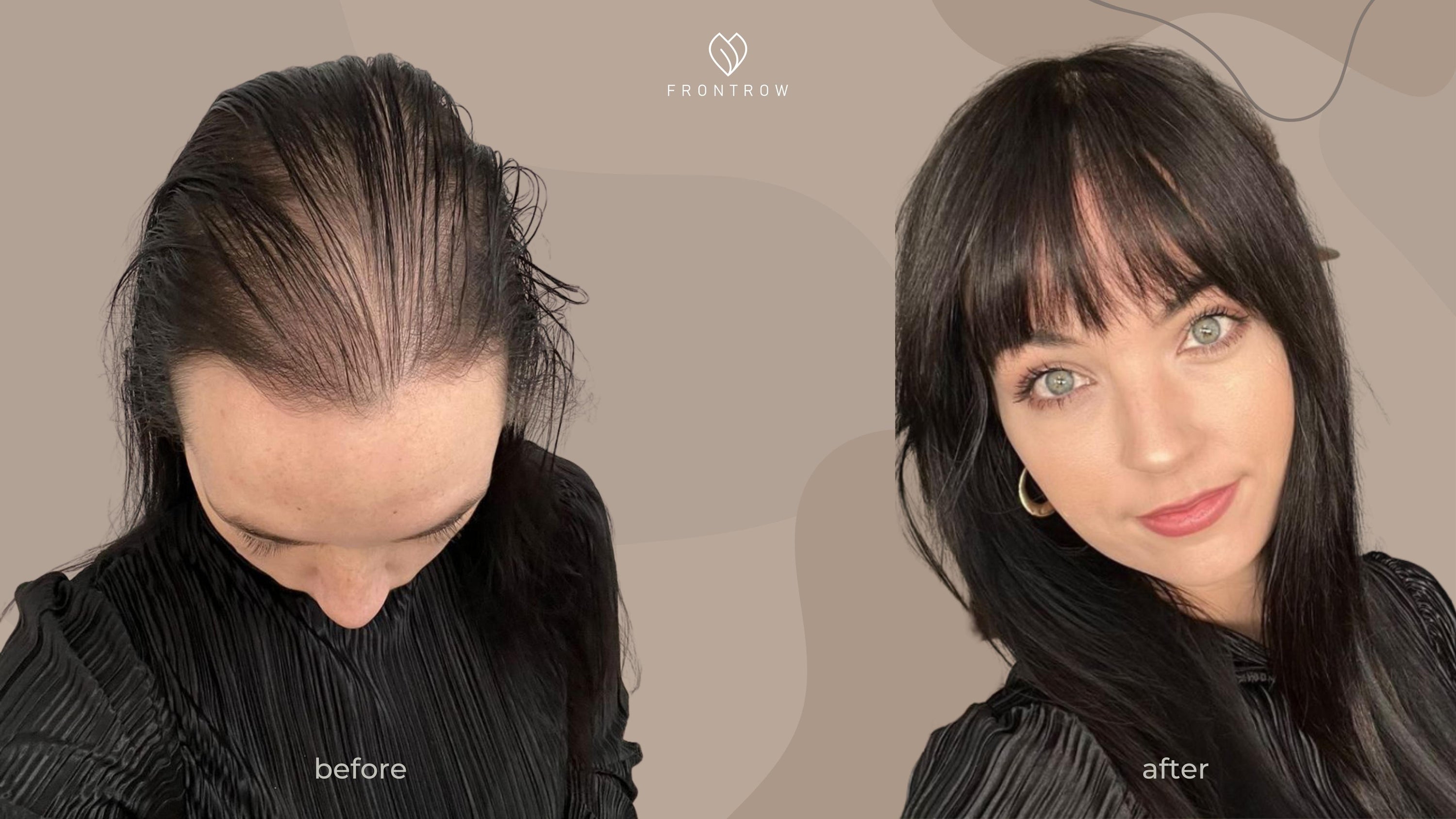 Before and after image of a woman suffering from hair loss wearing a Frontrow crown topper